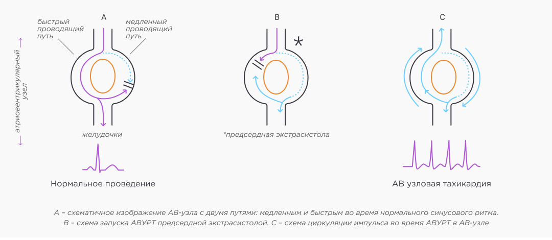 Механизм атриовентрикулярной узловой реципрокной тахикардии