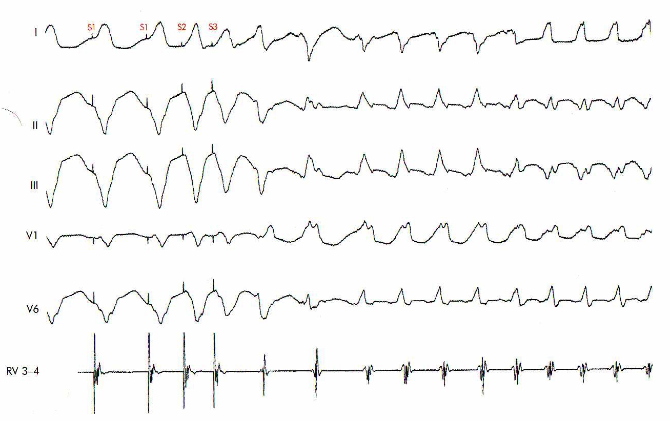 Индукция ЖТ у пациента с перенесенным инфарктом миокарда в анамнезе.