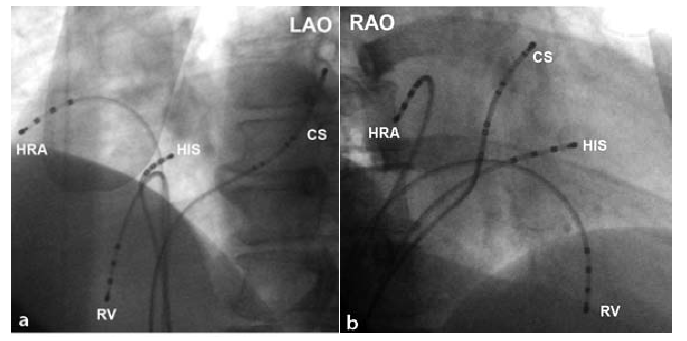 Рентгенологические изображения позицирования катетеров в проекциях LAO и RAO